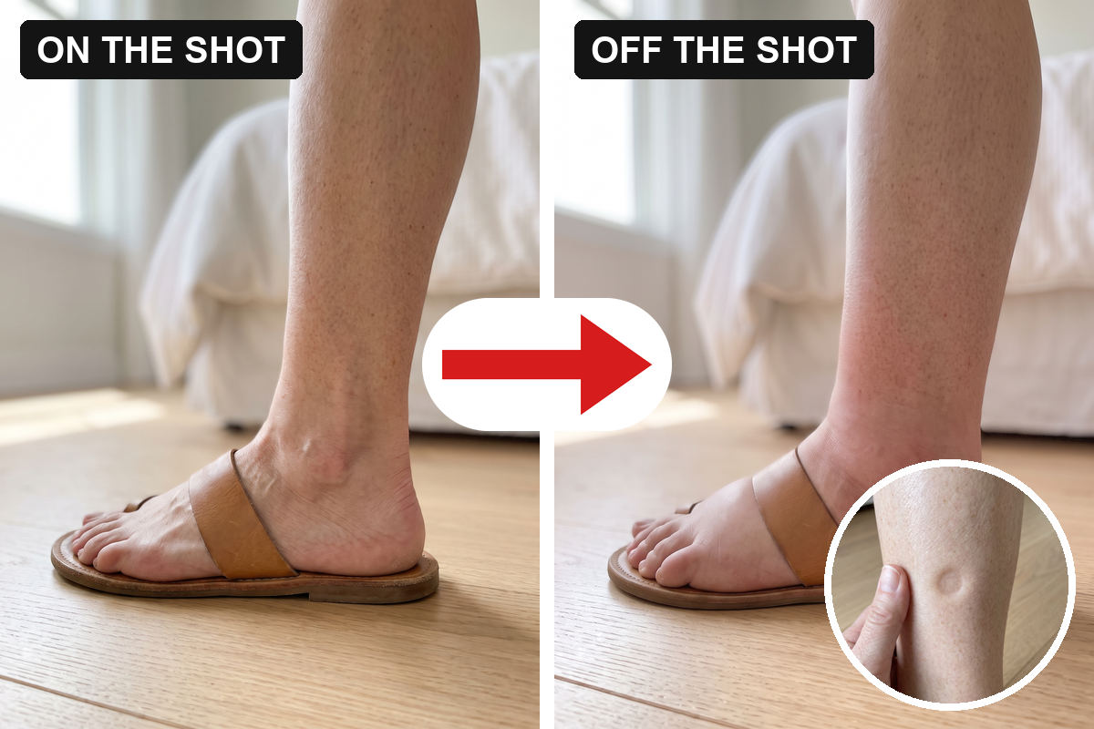 The same ankle on the shot, slim with the ankle bone showing, and off the shot, swollen with the bone gone and the sandal strap sinking in, with a close-up of a thumb dent left in the shin